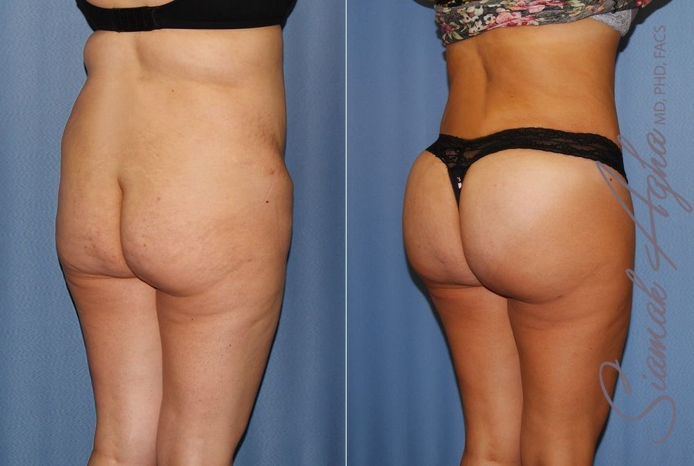Tummy Tuck Before & After