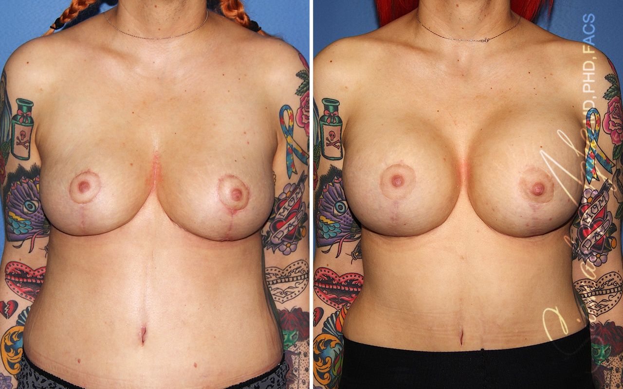 Breast Augmentation Before & After