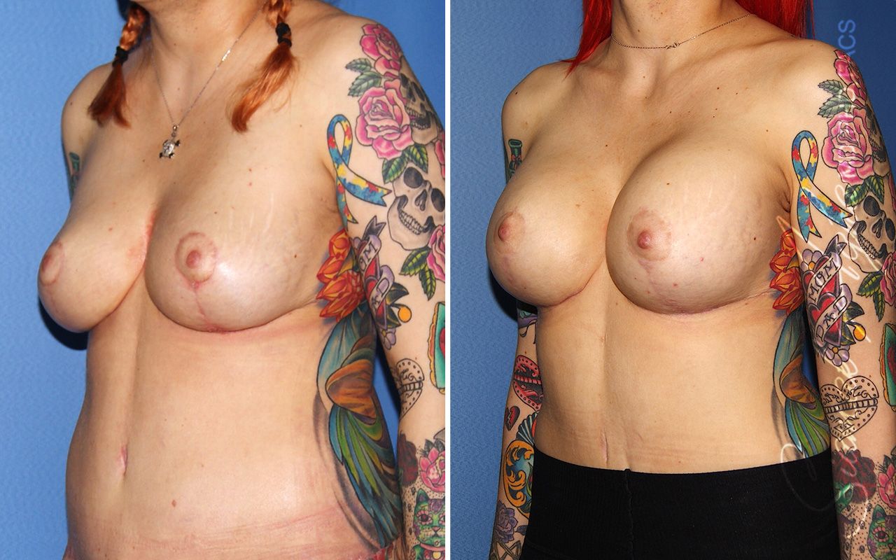 Breast Augmentation Before & After