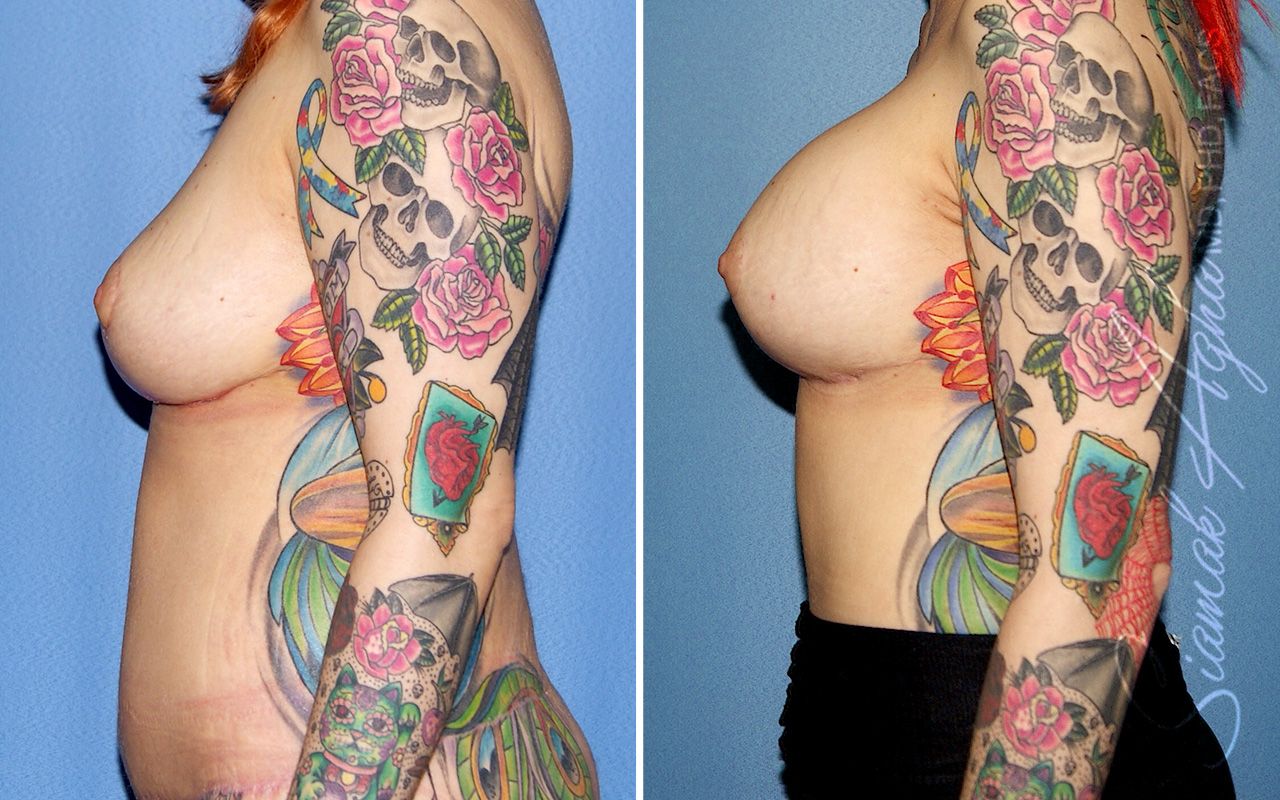 Breast Augmentation Before & After