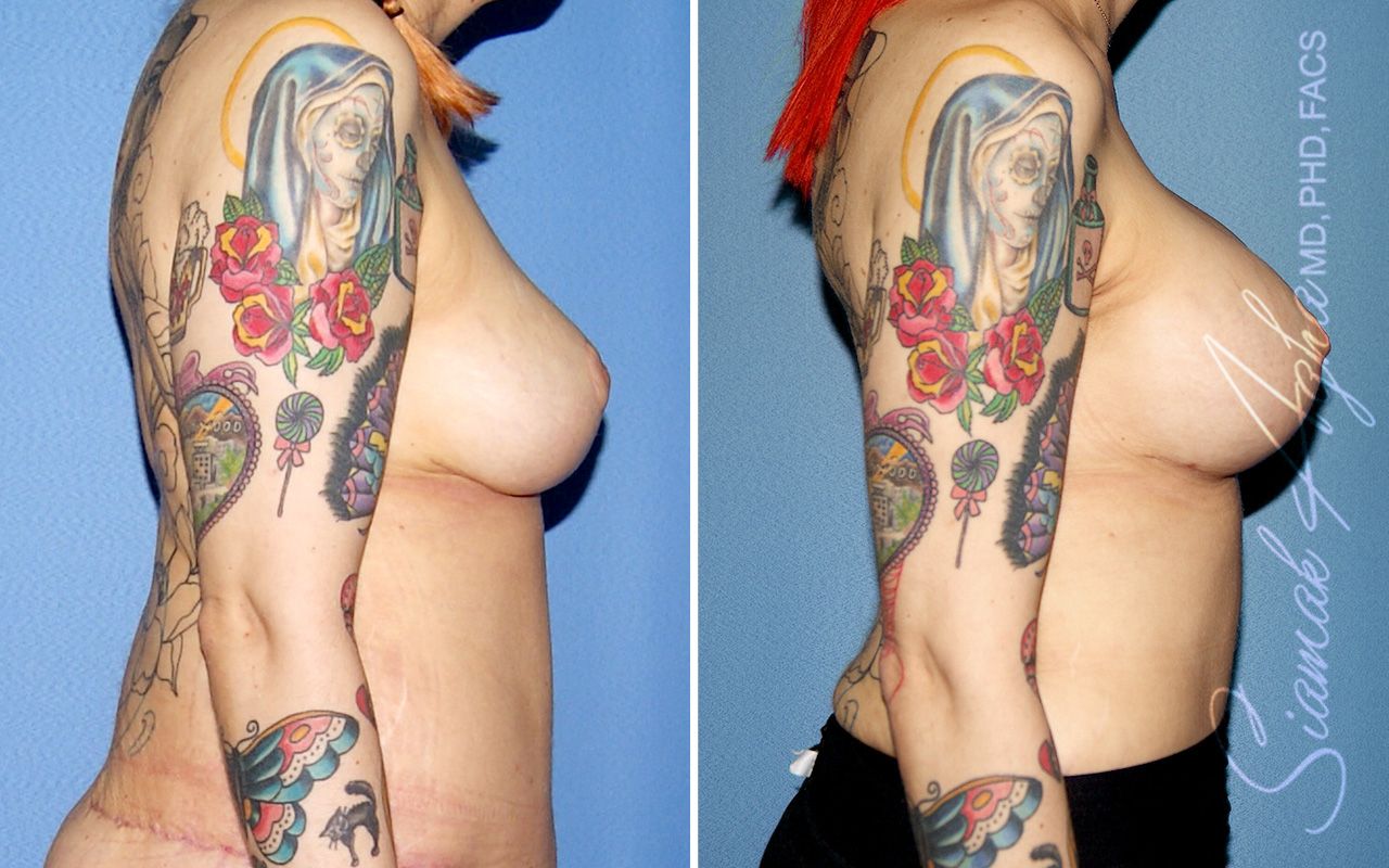 Breast Augmentation Before & After