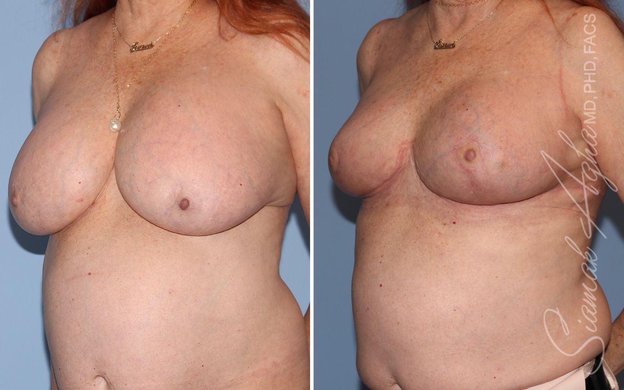 Breast Implant Removal Before & After