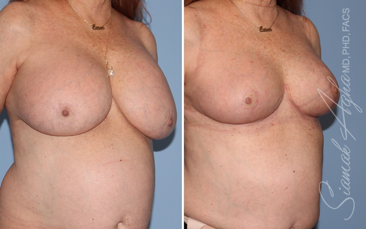 Breast Implant Removal Before & After