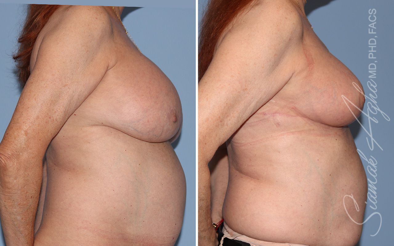 Breast Implant Removal Before & After