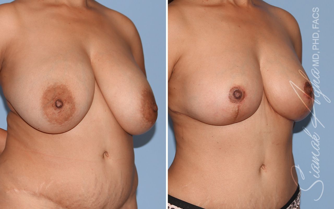 Breast Implant Removal Before & After