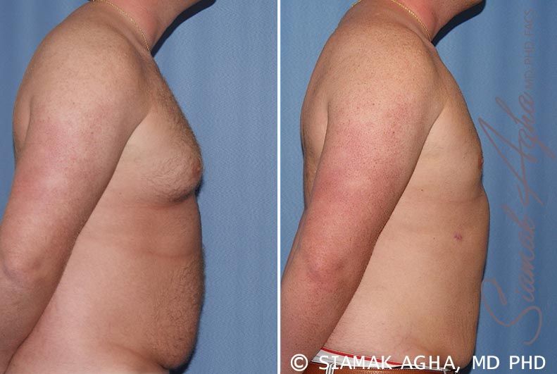 Male Breast Reduction Before & After