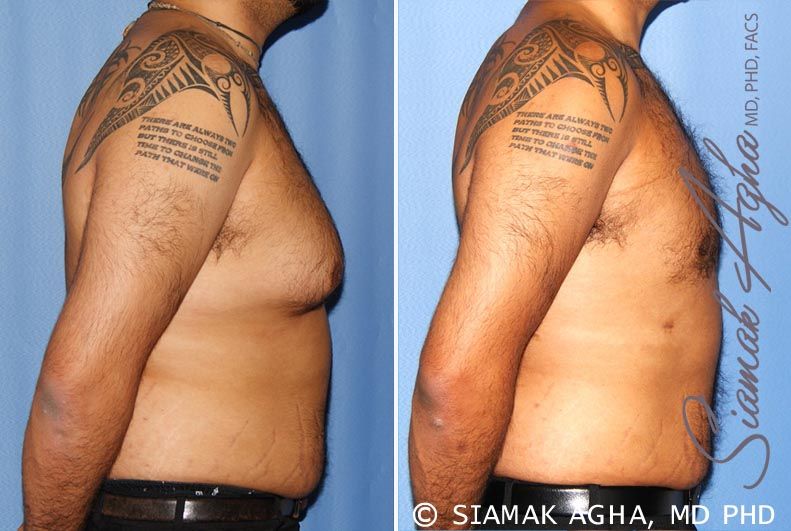 Male Breast Reduction Before & After