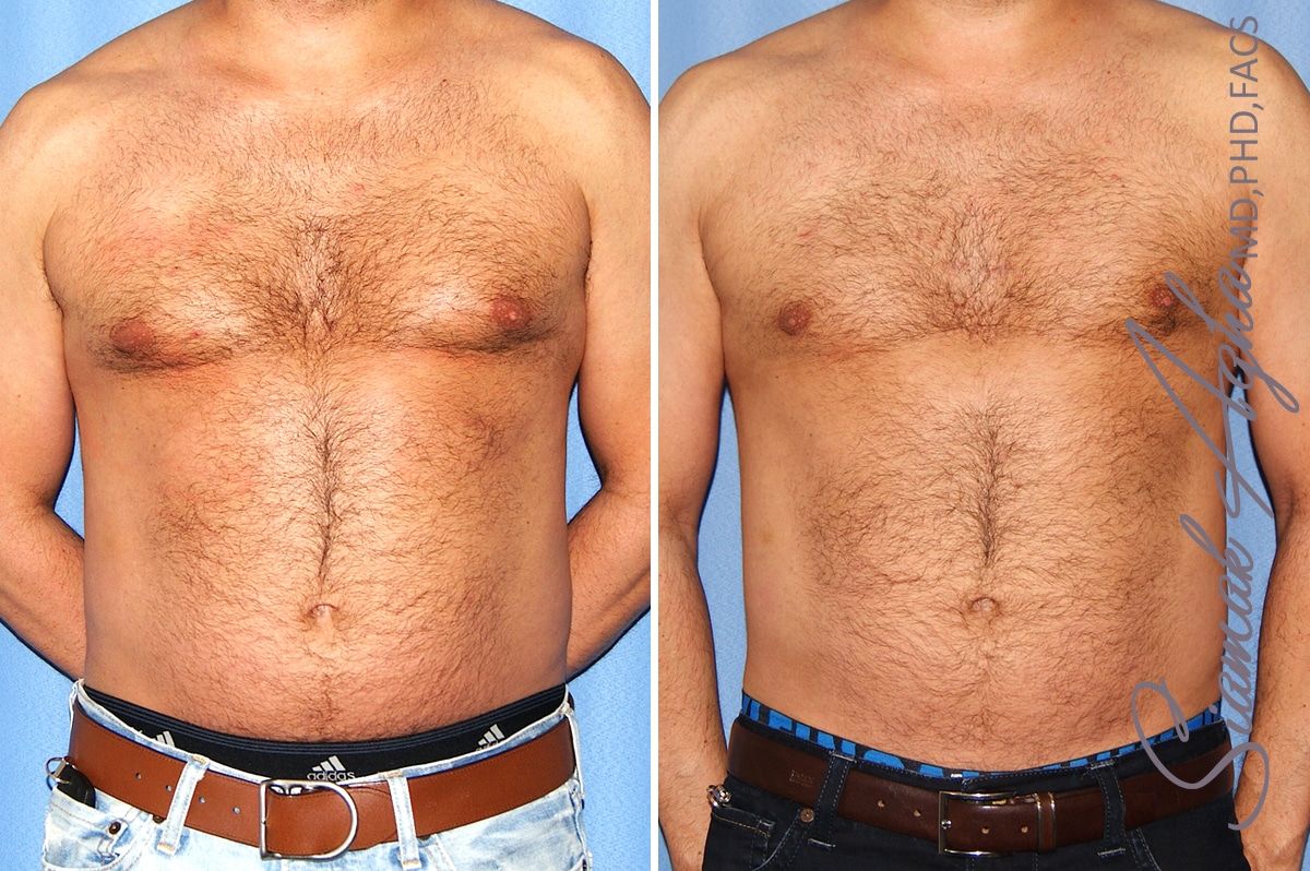 Male Breast Reduction Before & After