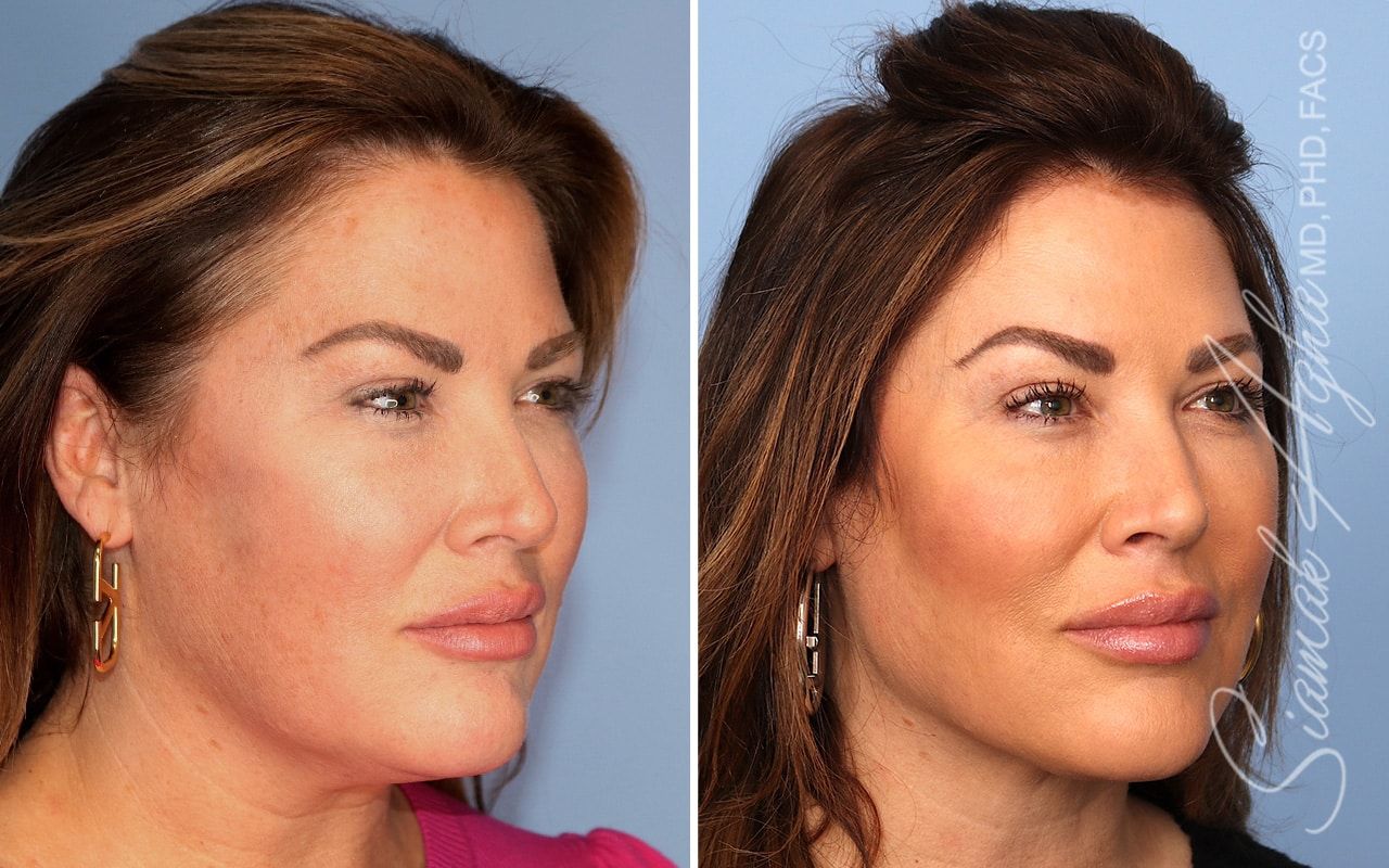 Facelift Before & After