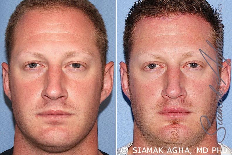Forehead Reduction Before & After