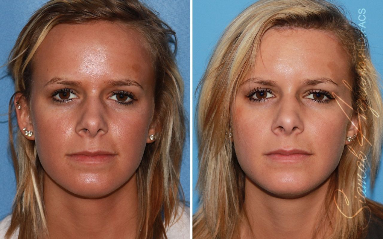 Forehead Reduction Before & After