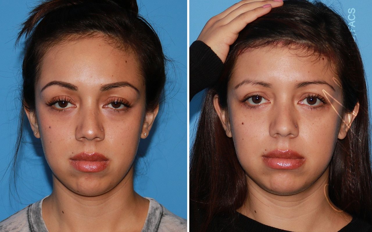 Forehead Reduction Before & After