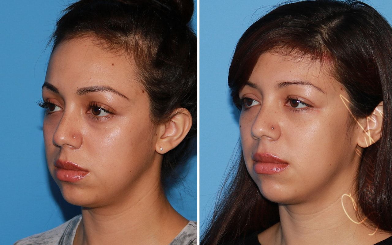 Forehead Reduction Before & After