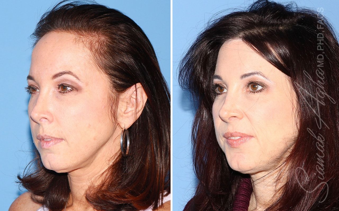 Forehead Reduction Before & After