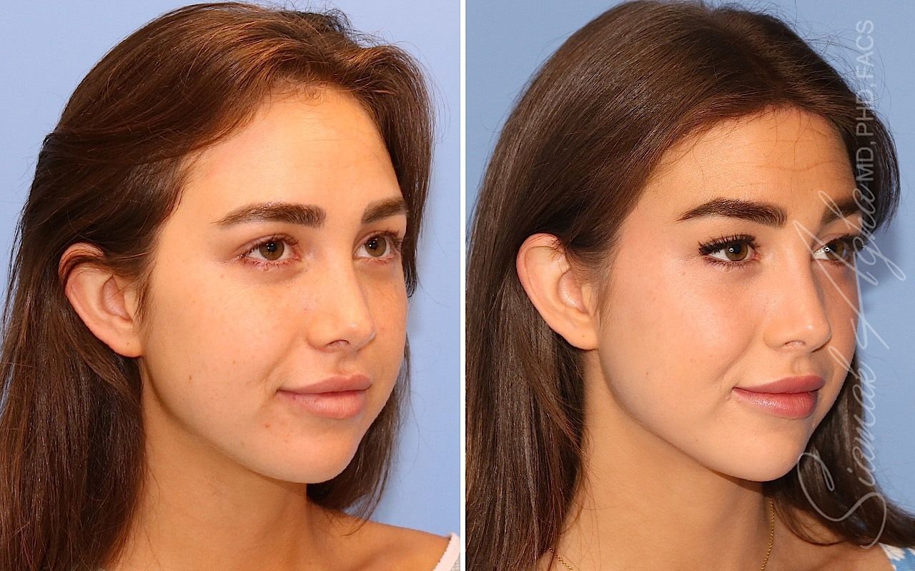 Forehead Reduction Before & After
