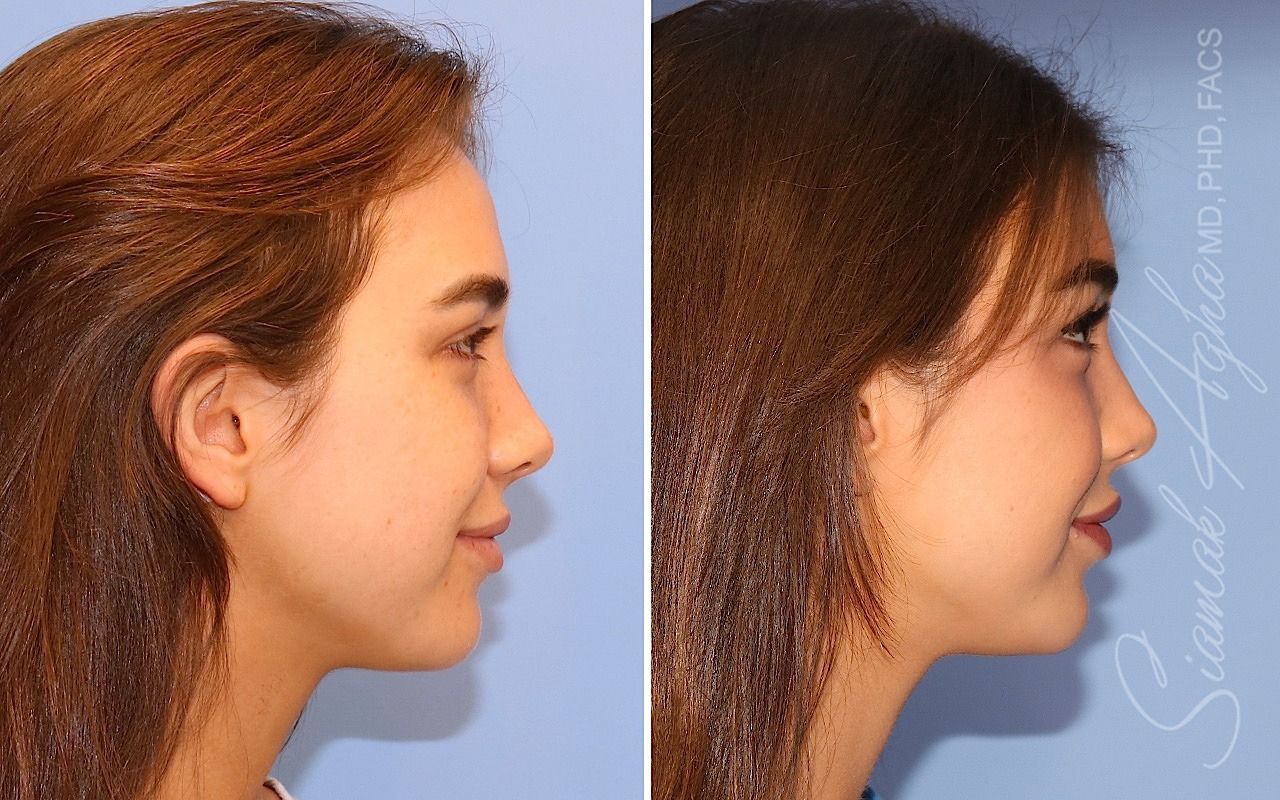 Forehead Reduction Before & After
