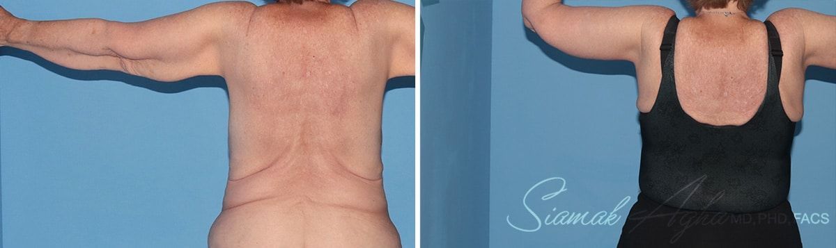  Before & After
