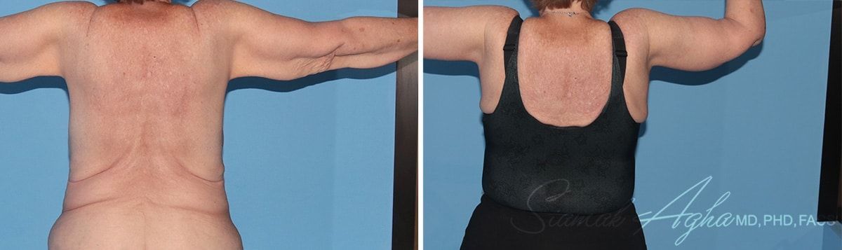  Before & After