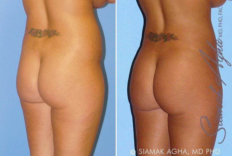 Liposuction Before & After