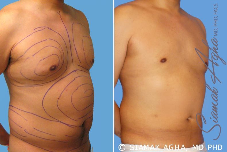 Liposuction Before & After