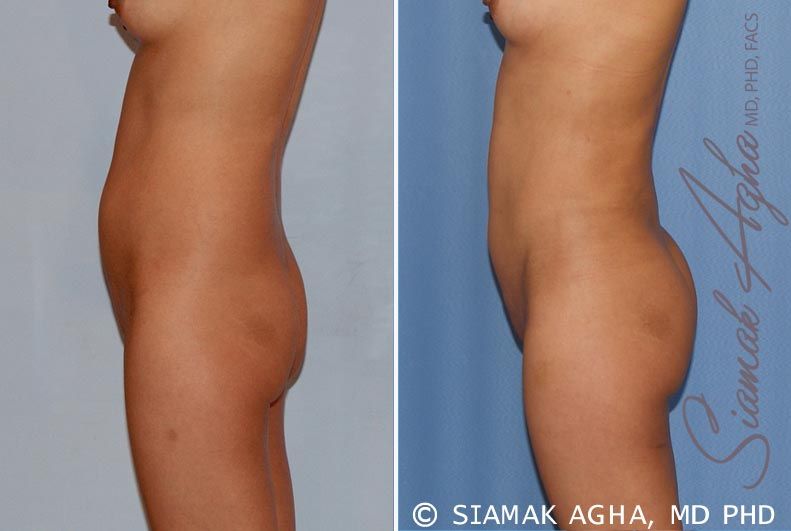 Liposuction Before & After
