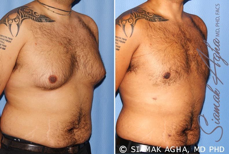 Liposuction Before & After