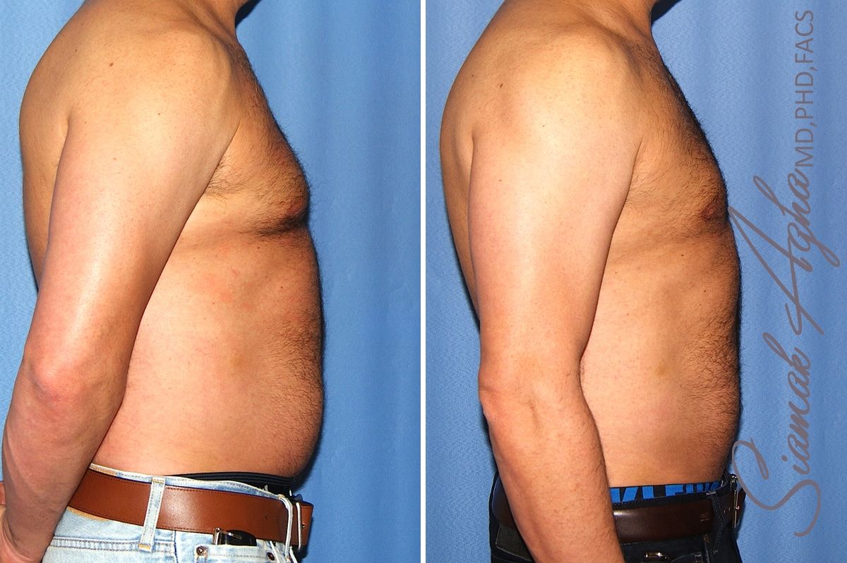 Liposuction Before & After