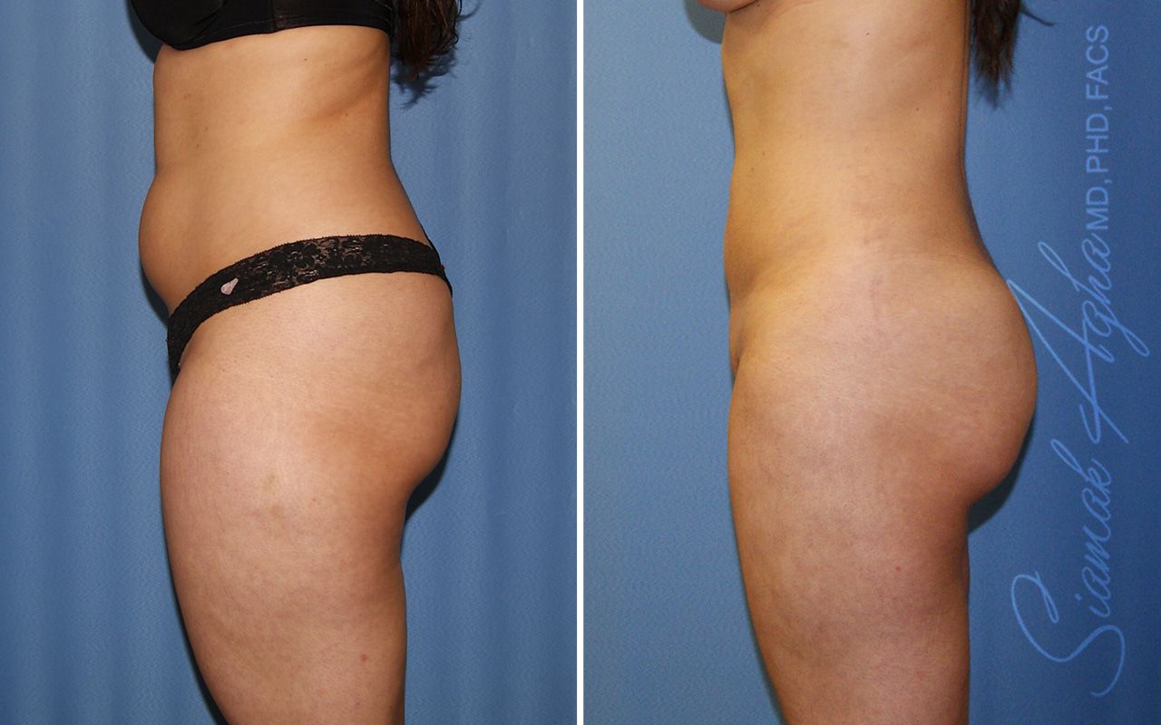 Liposuction Before & After