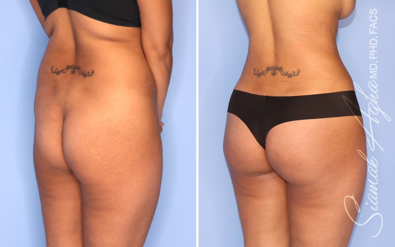 Liposuction Before & After