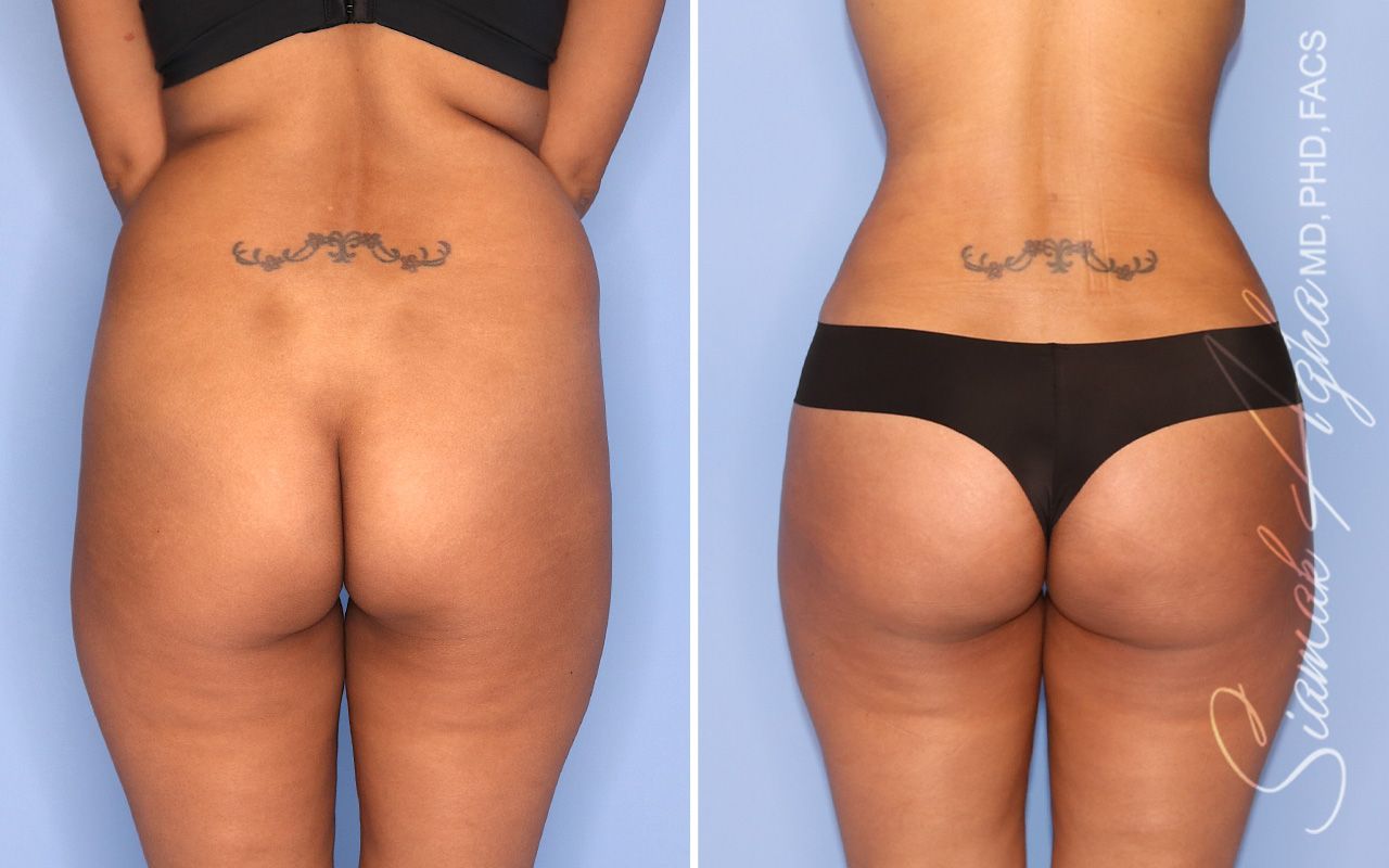 Liposuction Before & After