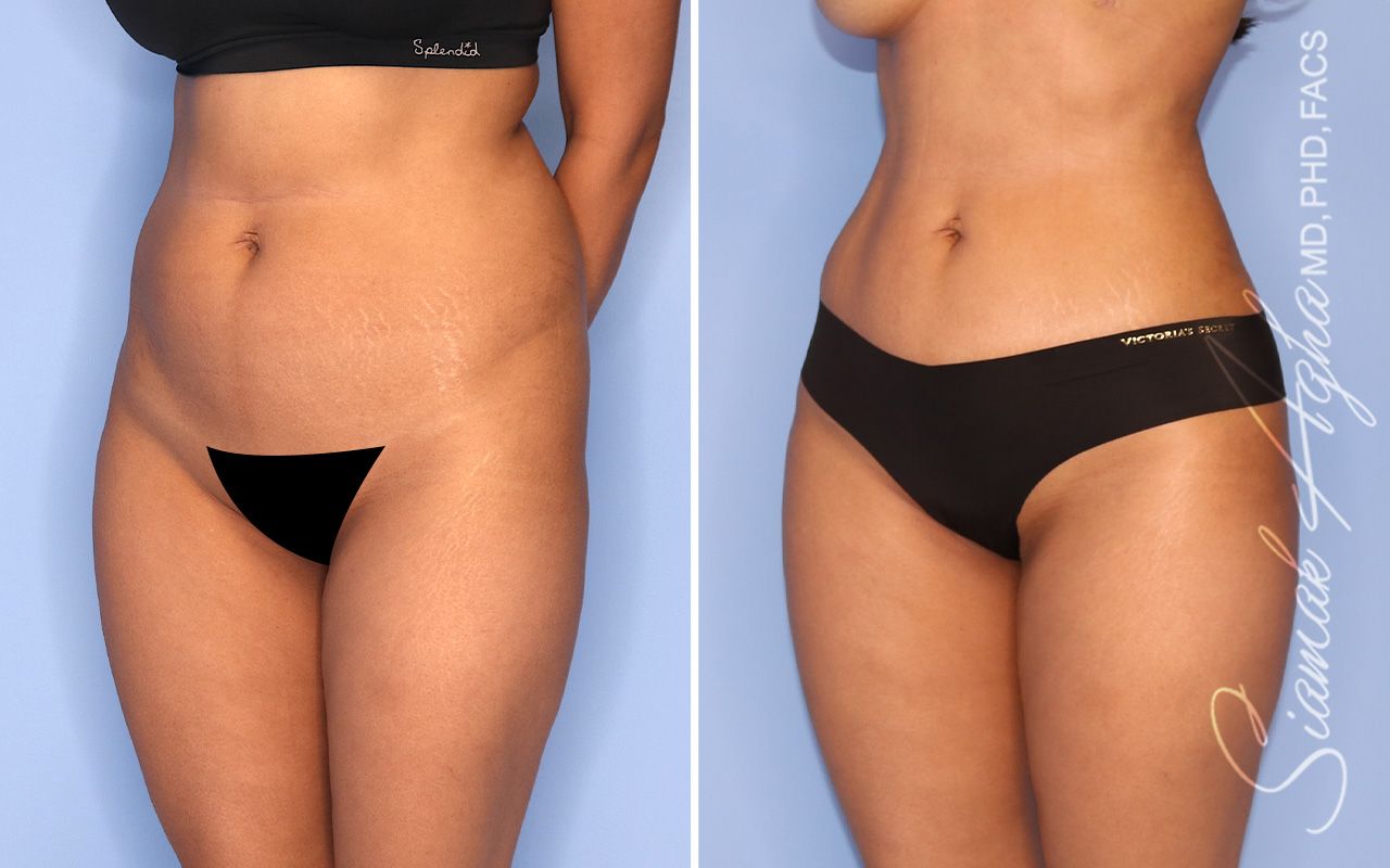 Liposuction Before & After