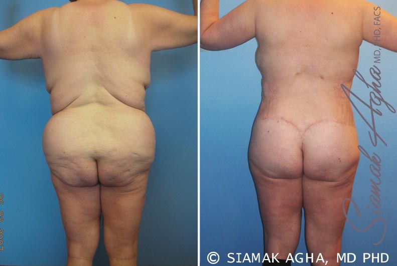 Total Body Lift Before & After