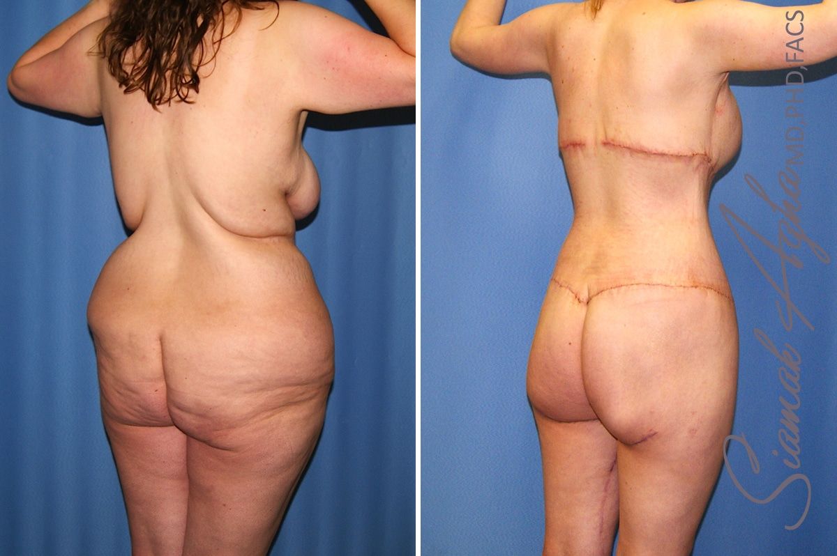 Total Body Lift Before & After
