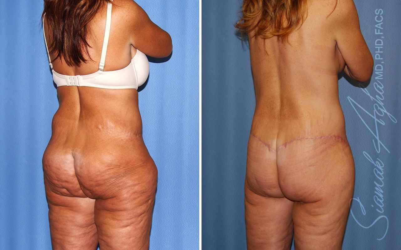 Total Body Lift Before & After