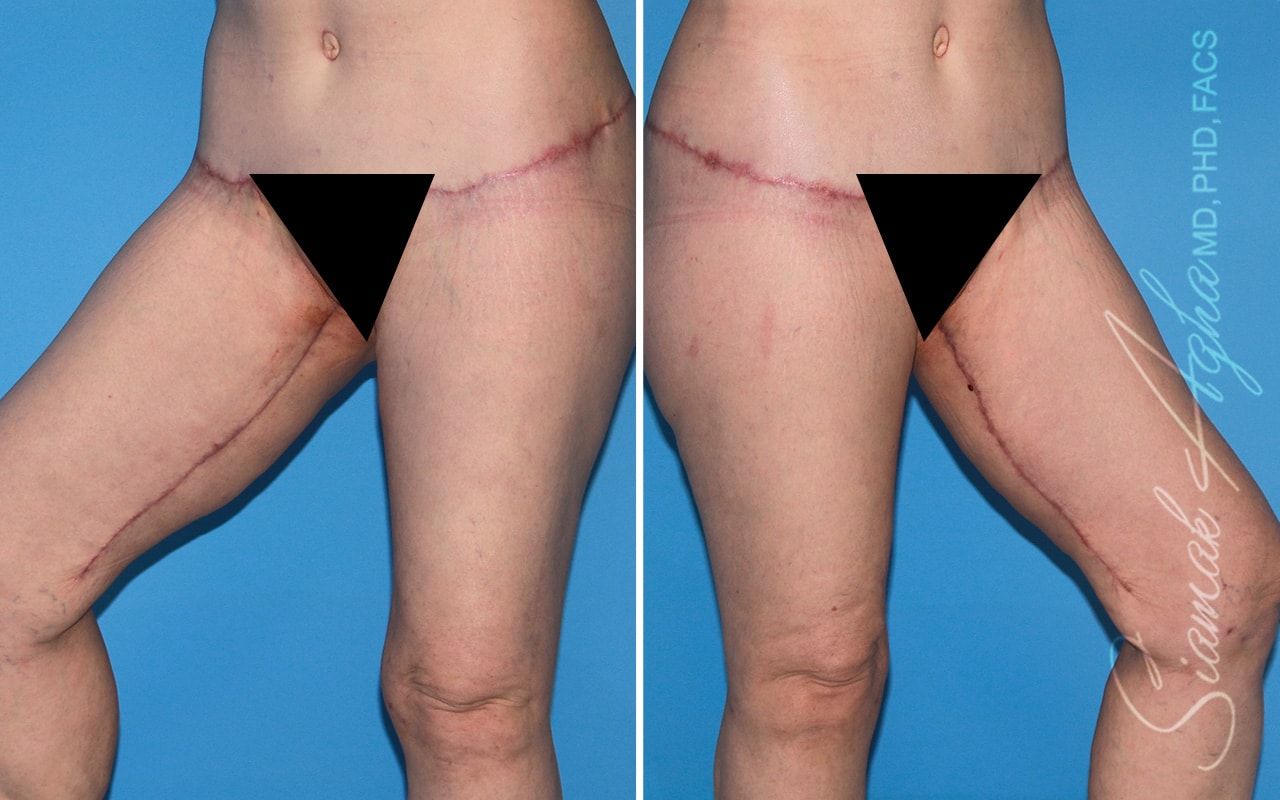 Total Body Lift Before & After