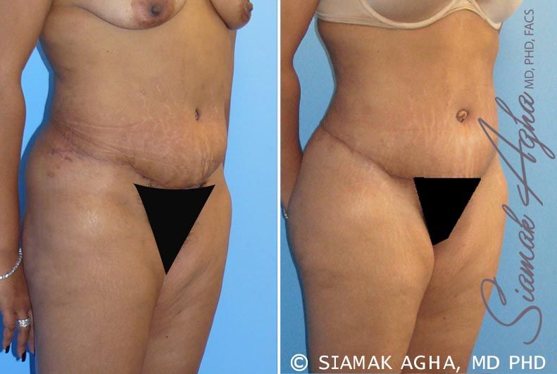 Tummy Tuck Revision Before & After