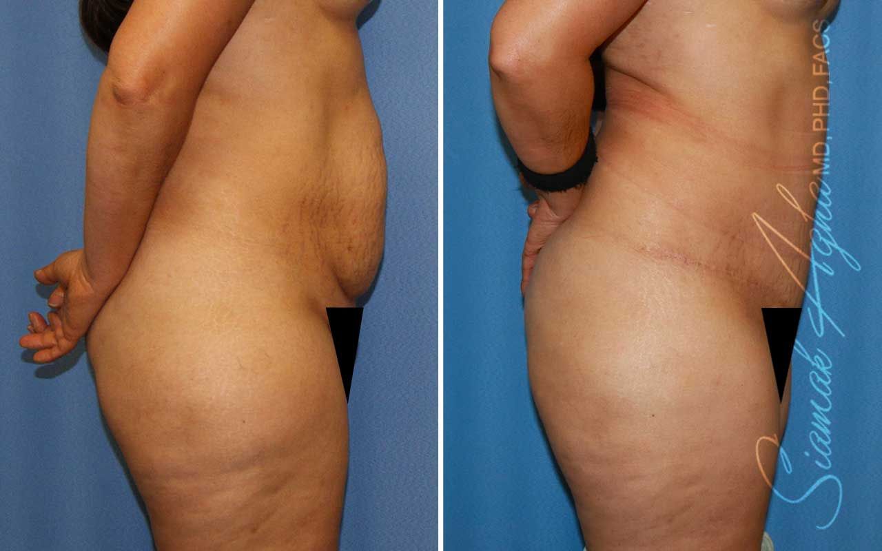 Partial Tummy Tuck Before & After