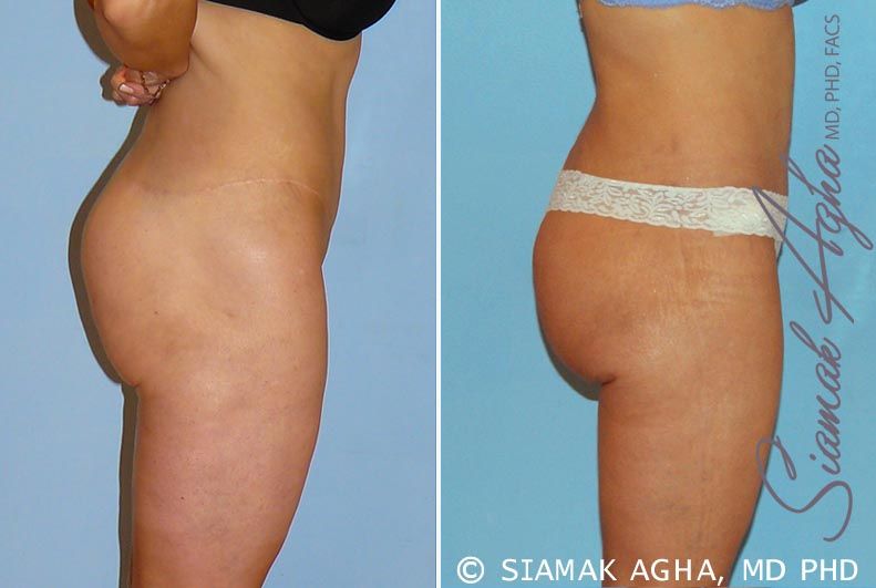 Spiral Thigh Lift Before & After