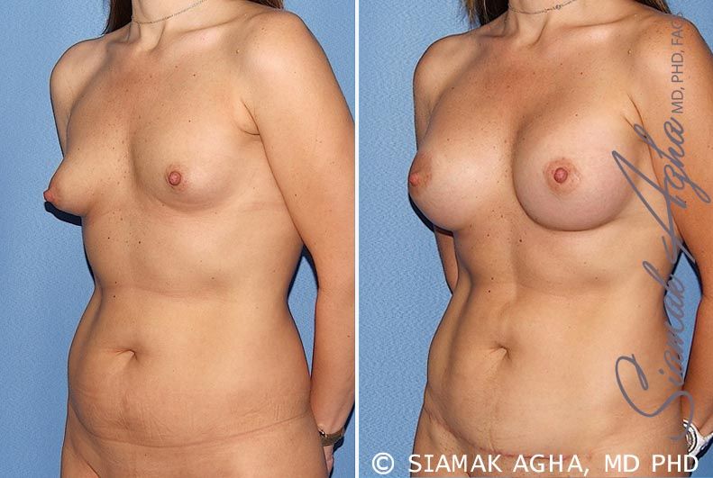 Breast Asymmetry Before & After