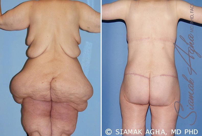 Buttock Reshaping After Weight Loss Before & After