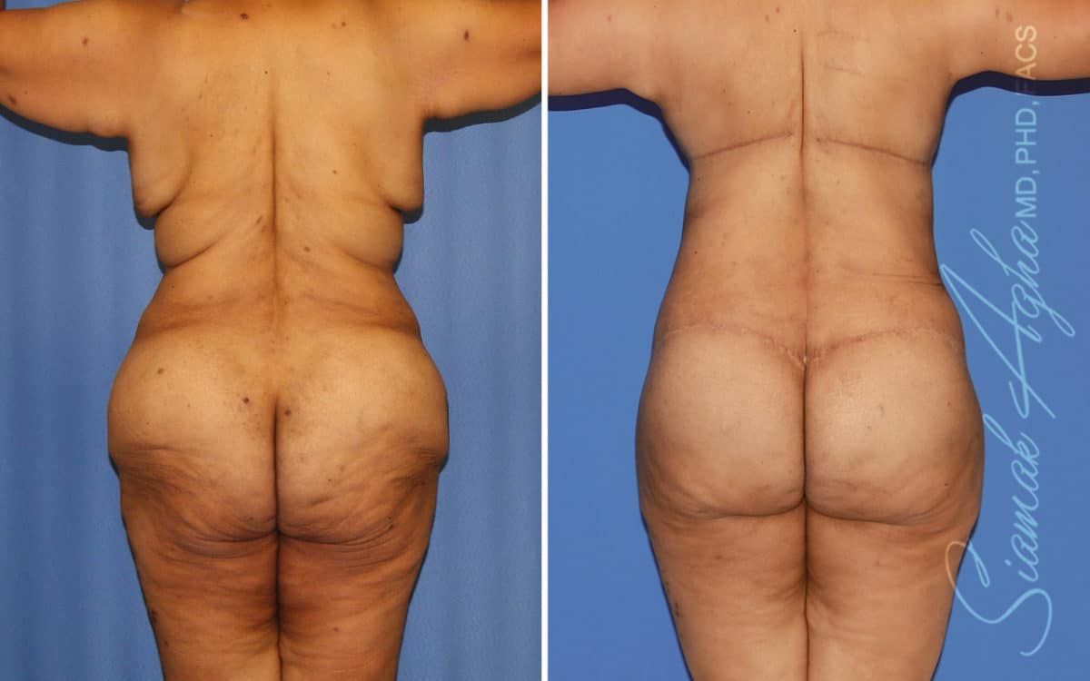 Buttock Reshaping After Weight Loss Before & After