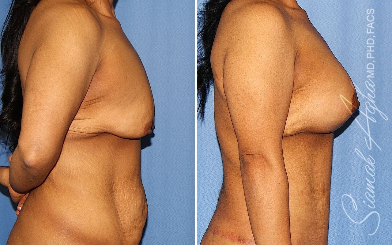 Tubular Breast Correction Before & After