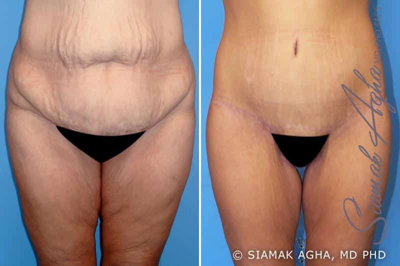 Lower Body Lift Before & After