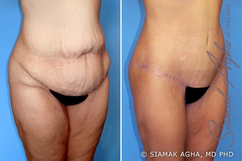 Lower Body Lift Before & After