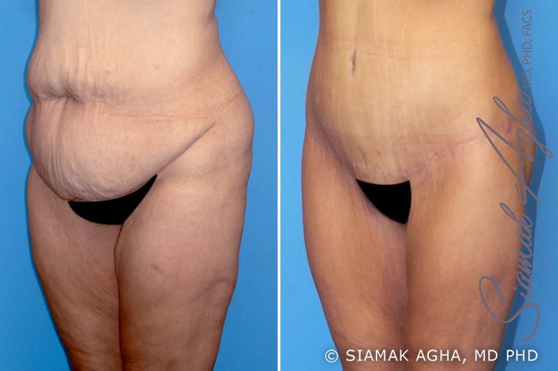 Lower Body Lift Before & After