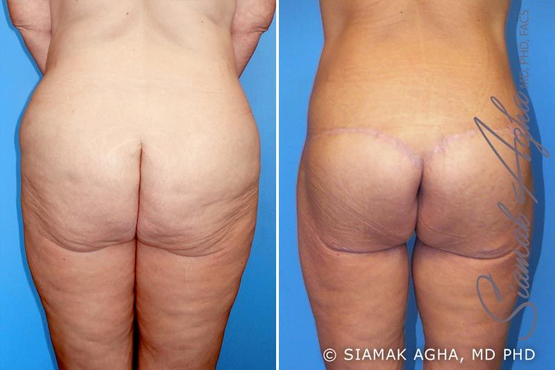 Lower Body Lift Before & After