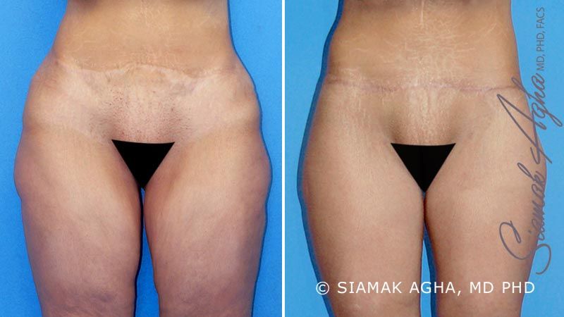 Lower Body Lift Before & After