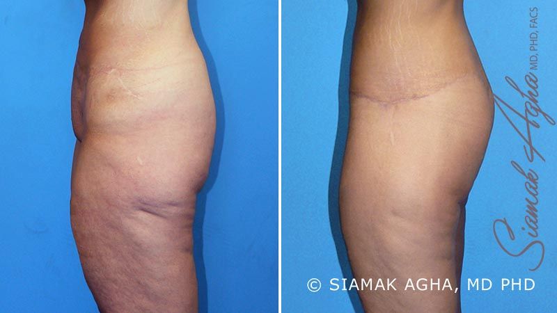 Lower Body Lift Before & After