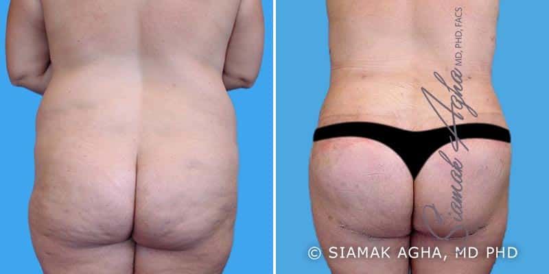 Lower Body Lift Before & After