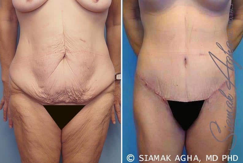 Lower Body Lift Before & After